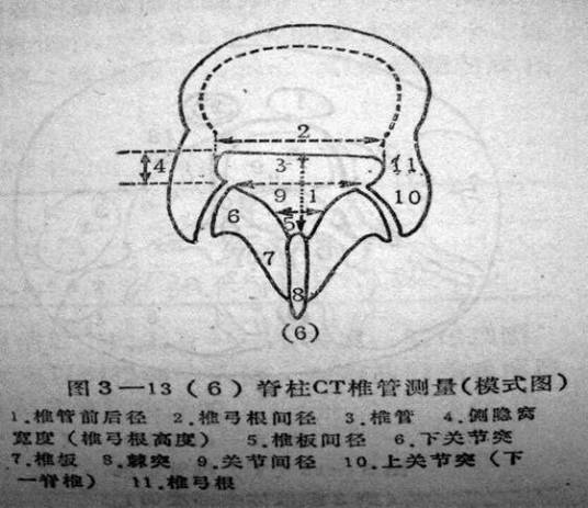 侧隐窝