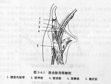 股动脉穿刺术