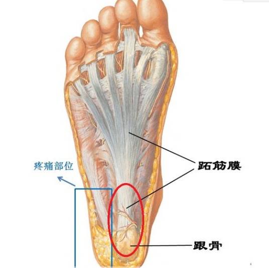 跟骨骨膜炎