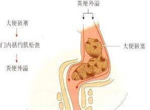 产后大便失禁