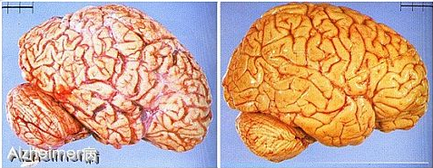 家族性ALZHEIMER病