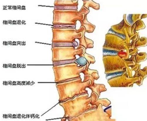 腰椎退变