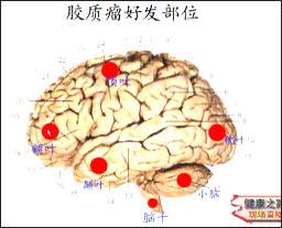 脑神经胶质瘤