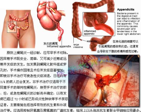 急慢性阑尾炎