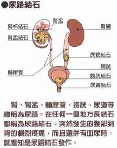 上尿路结石