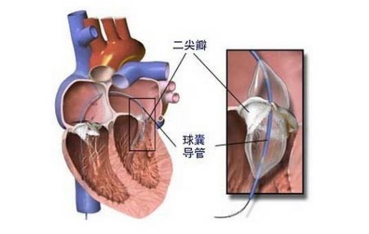 二尖瓣