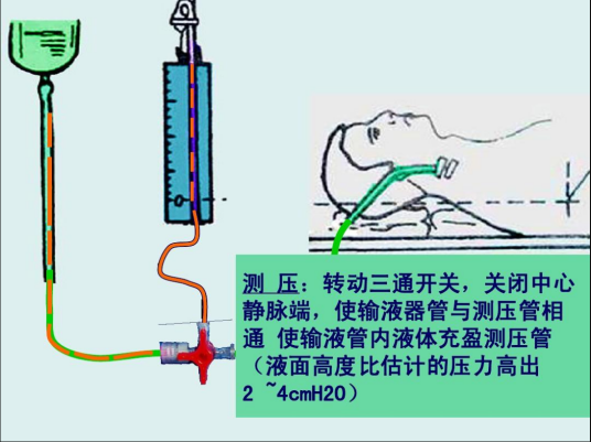 中心静脉压测定