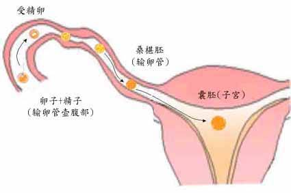 输卵管闭塞