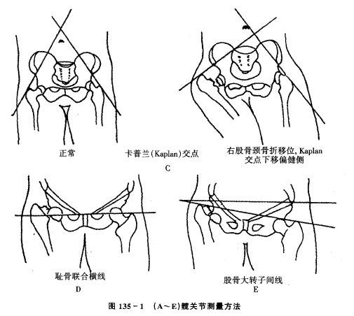 Kaplan交点