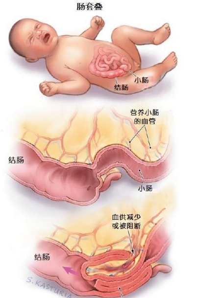 婴幼儿灌肠法