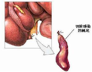 老年性急性阑尾炎